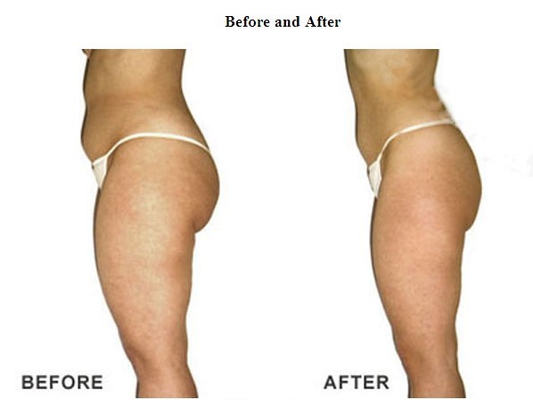 Inner Thigh Fat Removal 85