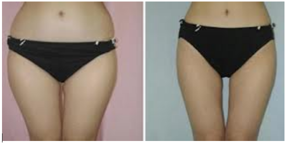 Inner Thigh Fat Removal 115