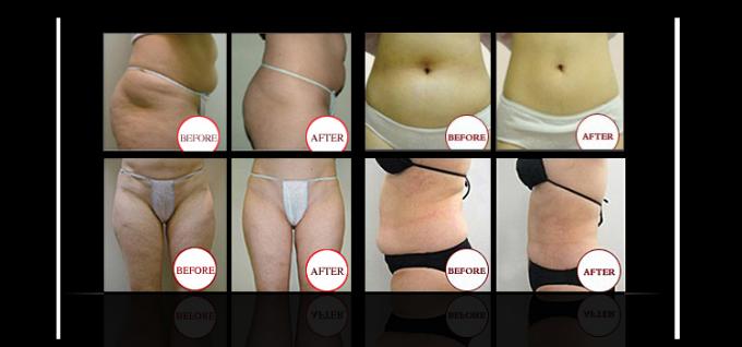 Powerful!!!cryolipolysis machine/ultrasonic liposuction cavitation cryolipolysis fat freezing machine for sale