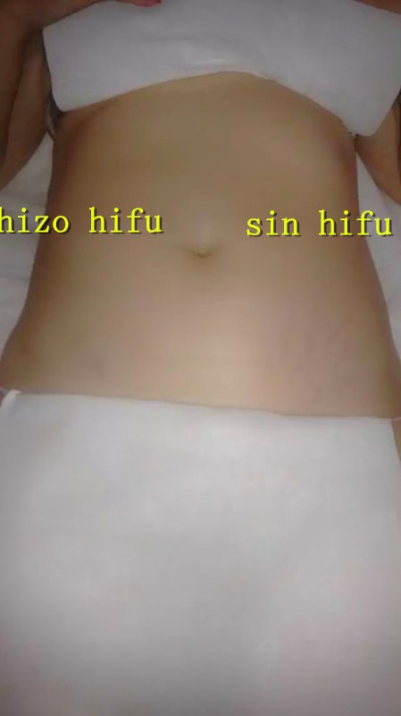 Instant Face Lift Hifu Machine Wrinkle Removal Machine High Intensity Focused